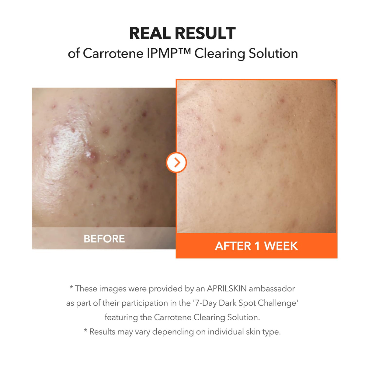 Aprilskin IPMP Clearing Solution 20ml